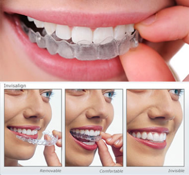 Invisalign